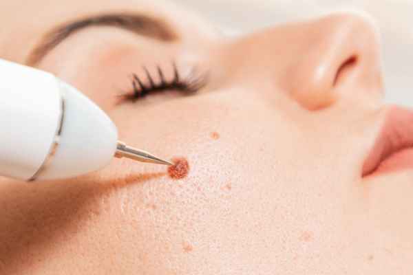 CryoPen: 5 Skin Concerns It May Be Used to Treat 3 What actually happens during a CryoPen treatment East Mersea?