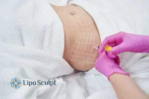 Are The Results From Aqualyx Permanent? 1 Do you want to know how long Aqualyx East Mersea results last?