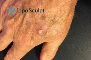 Best Actinic Keratoses Removal 2 Improve your wellbeing and health with Actinic Keratoses East Mersea removal.treatment