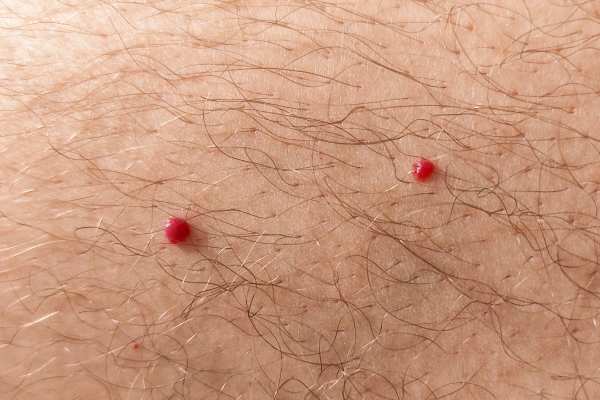 CryoPen: 5 Skin Concerns It May Be Used to Treat 2 cherry angioma removal East Mersea