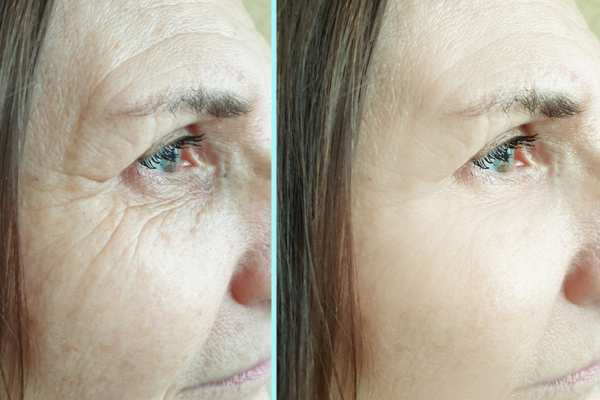 Why Do People Choose HIFU for a Non-Surgical Facelift? 4 How long can HIFU results last East Mersea?