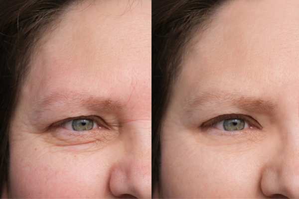 HIFU vs Botulinum Toxin: Understanding the Differences 4 How long do HIFU results last East Mersea?