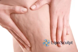 CoolSculpting for Legs: The Innovative Approach to Redefining Your Legs 5 Start your journey today book your coolsculpting treatment East Mersea online today!
