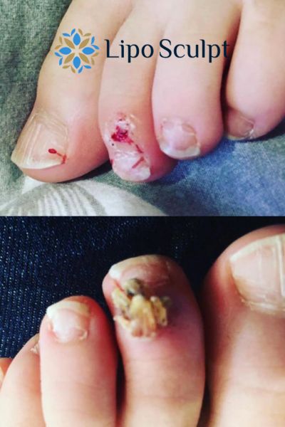 Wart removal customer results from Lipo Sculpt East Mersea